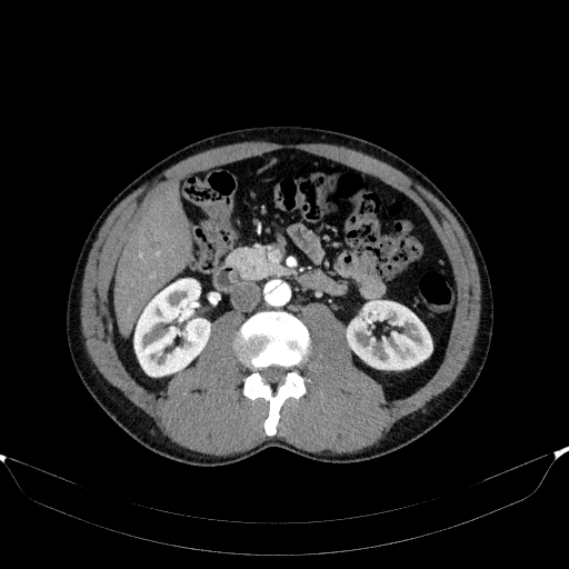 Aortic dissection - Stanford type A (Radiopaedia 83418-98500 A 76).jpg