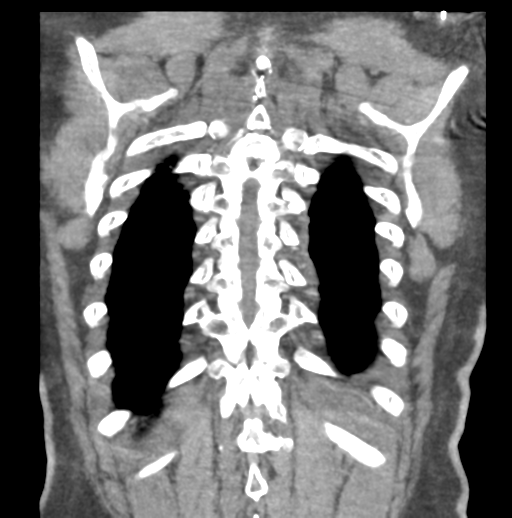 File:Aortic dissection - Stanford type B (Radiopaedia 50171-55512 B 74).png