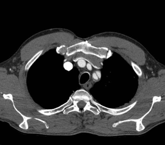 File:Aortic dissection - Stanford type B (Radiopaedia 73648-84437 A 8).jpg