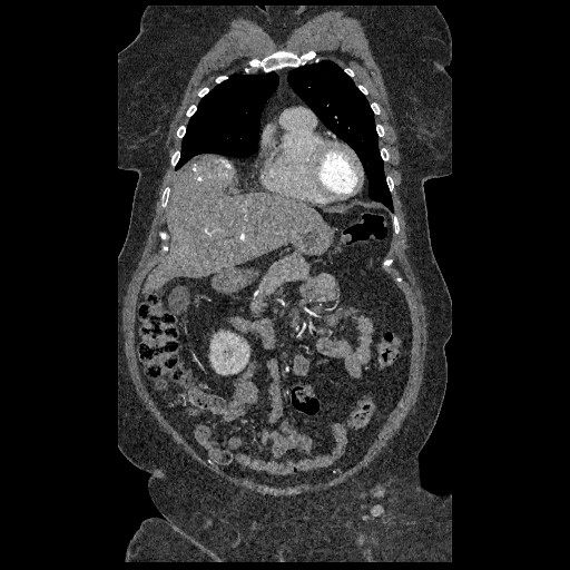 File:Aortic dissection - Stanford type B (Radiopaedia 88281-104910 B 13).jpg