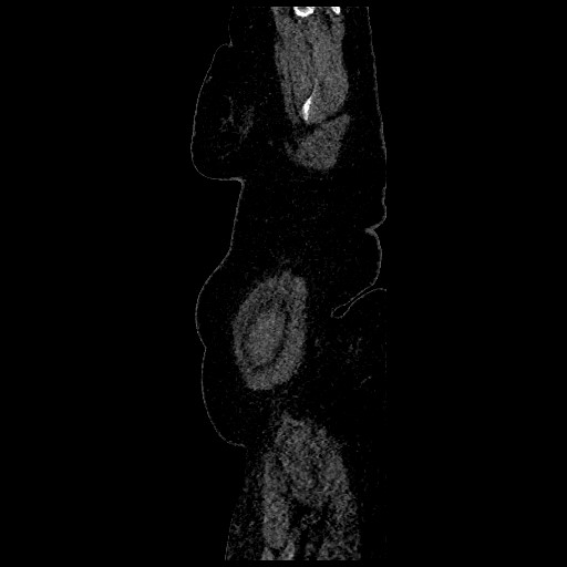 Aortic dissection - Stanford type B (Radiopaedia 88281-104910 C 84).jpg