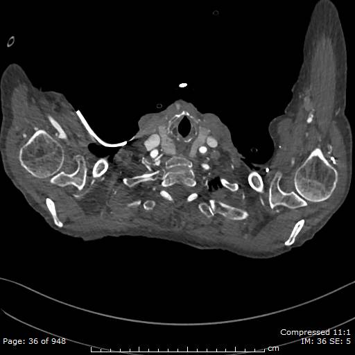 File:Aortic dissection with extension into aortic arch branches (Radiopaedia 64402-73204 B 36).jpg