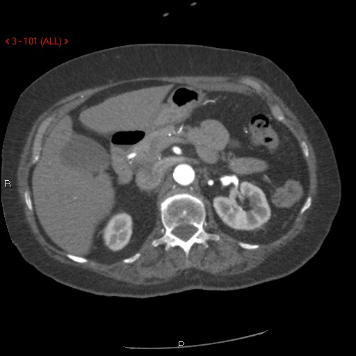 File:Aortic intramural hematoma (Radiopaedia 27746-28001 A 101).jpg