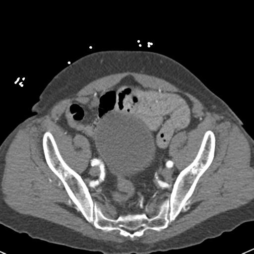 Aortic intramural hematoma (Radiopaedia 31139-31838 B 146).jpg