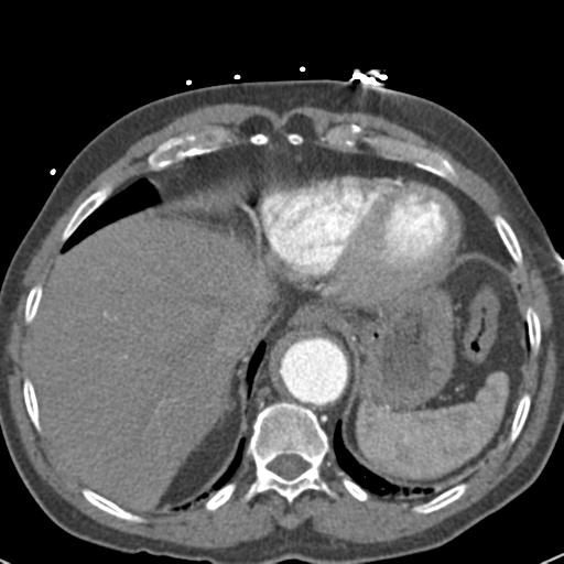 File:Aortic intramural hematoma (Radiopaedia 31139-31838 B 72).jpg