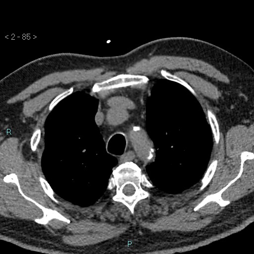 File:Aortic intramural hematoma (Radiopaedia 48463-53380 Axial non-contrast 37).jpg