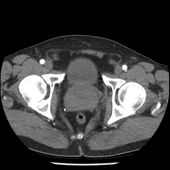 Aortic intramural hematoma (type B) (Radiopaedia 79323-92387 B 112).jpg