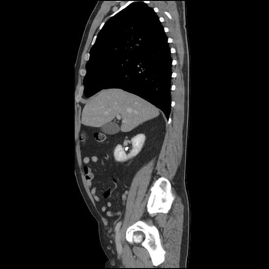 Aortic intramural hematoma (type B) (Radiopaedia 79323-92387 Sagittal C+ delayed 12).jpg