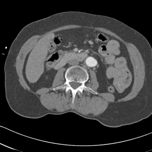 File:Aortic intramural hematoma from penetrating atherosclerotic ulcer (Radiopaedia 31137-31836 A 110).jpg