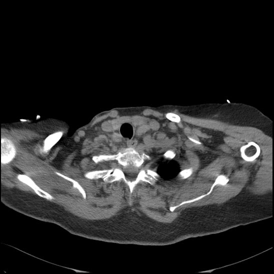 Aortic intramural hematoma with dissection and intramural blood pool (Radiopaedia 77373-89491 Axial non-contrast 13).jpg