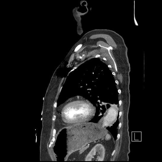 Aortic intramural hematoma with dissection and intramural blood pool (Radiopaedia 77373-89491 D 66).jpg