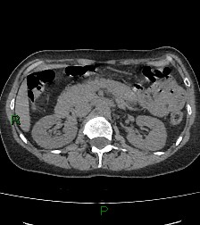 Aortic valve endocarditis (Radiopaedia 87209-103485 Axial non-contrast 108).jpg