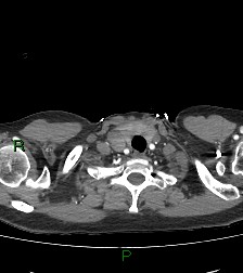 Aortic valve endocarditis (Radiopaedia 87209-103485 C 5).jpg