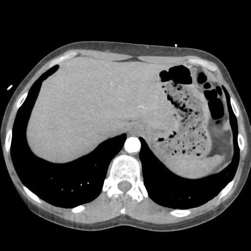 File:Aortic valve non-coronary cusp thrombus (Radiopaedia 55661-62189 B 45).png