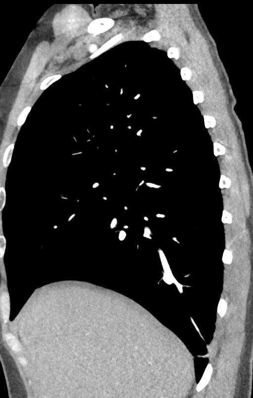 Aortic valve non-coronary cusp thrombus (Radiopaedia 55661-62189 C+ arterial phase 52).png