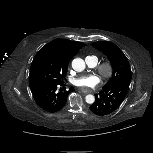 File:Aortoesophageal fistula with endovascular repair (Radiopaedia 73781-84592 Axial 37).jpg