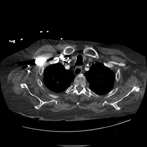 File:Aortoesophageal fistula with endovascular repair (Radiopaedia 73781-84592 Axial C+ CTPA 8).jpg