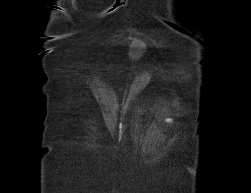 Aortoesophageal fistula with endovascular repair (Radiopaedia 73781-84592 Coronal C+ CTPA 139).jpg