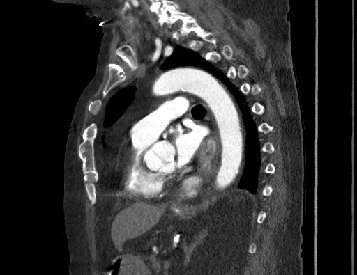 Aortoesophageal fistula with endovascular repair (Radiopaedia 73781-84592 Sagittal C+ CTPA 116).jpg