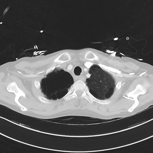 Apical bullous disease in a heavy smoker (Radiopaedia 33067-34092 Axial lung window 10).png