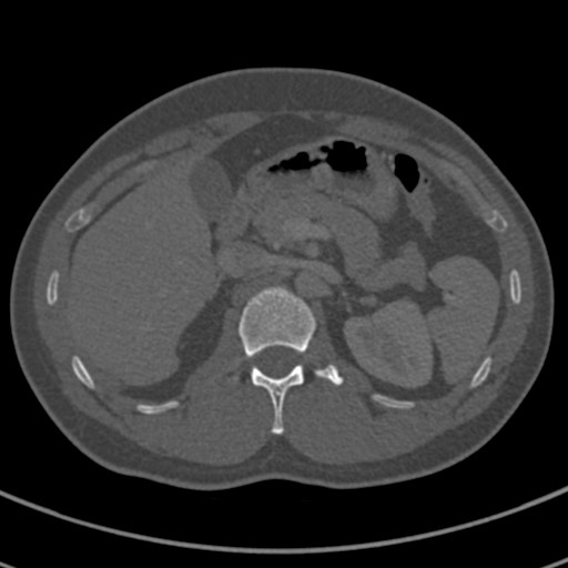 File:Apical lung mass mimic - neurogenic tumor (Radiopaedia 59918-67521 Axial bone window 89).jpg