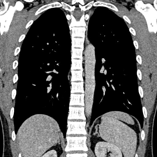 File:Apical lung mass mimic - neurogenic tumor (Radiopaedia 59918-67521 B 75).jpg