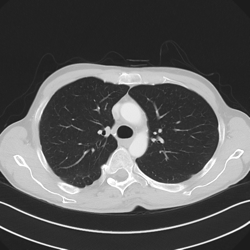 Apical pleural calcification (Radiopaedia 46141-50499 Axial lung window 23).png