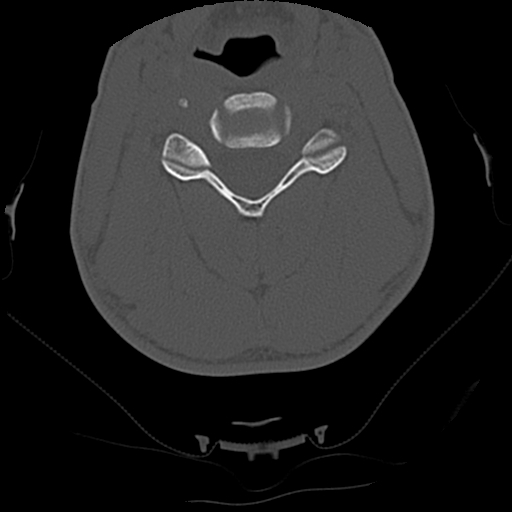 Apical pneumothorax on cervical spine CT (Radiopaedia 45343-49368 Axial bone window 46).jpg