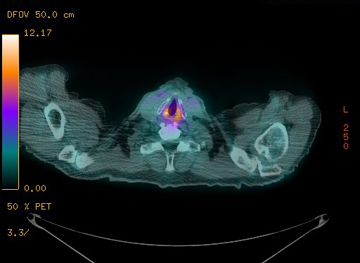 Appendiceal adenocarcinoma complicated by retroperitoneal abscess (Radiopaedia 58007-65041 Axial PET-CT 24).jpg