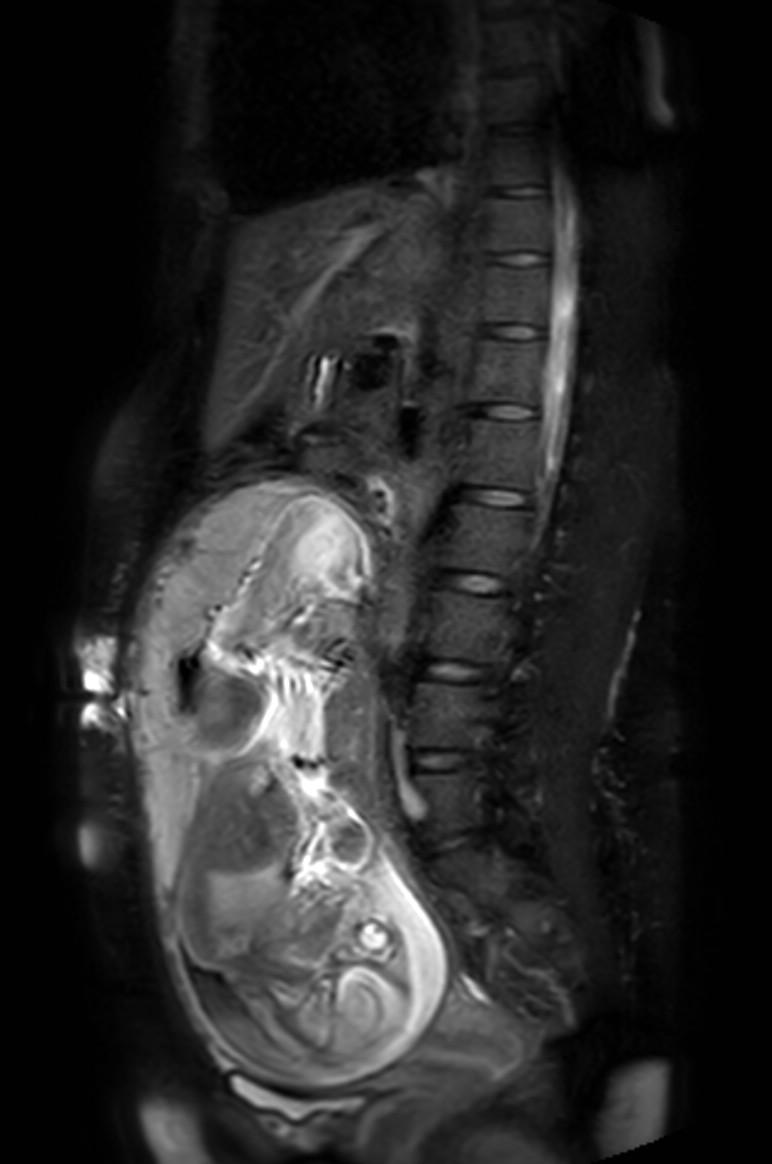 Appendicitis in gravida (MRI) (Radiopaedia 89433-106395 Sagittal T2 SPAIR 29).jpg
