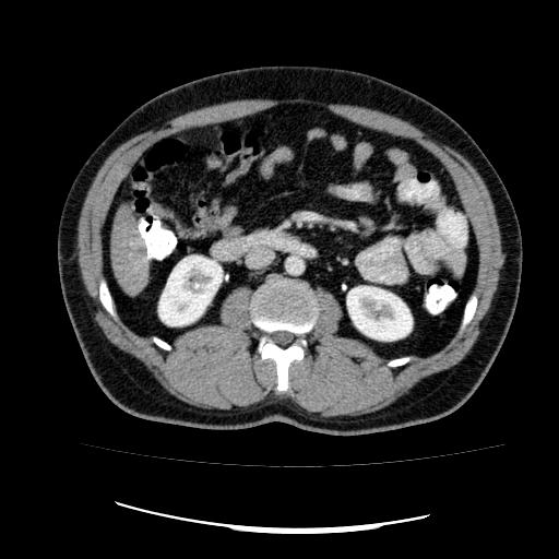 File:Appendicitis with diverticulosis (Radiopaedia 47693-52383 Axial C+ 63).jpg