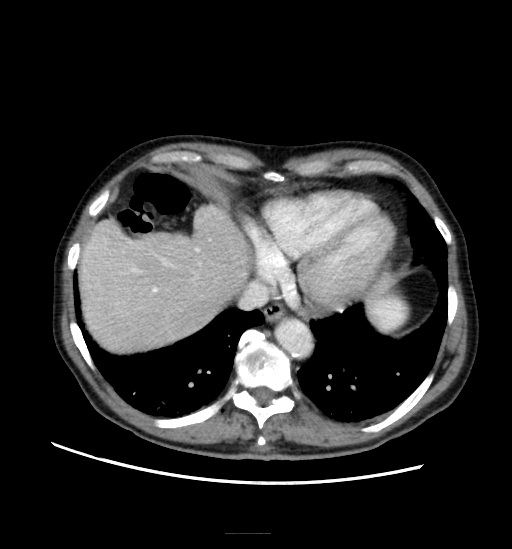 Appendicitis with localized perforation and abscess formation (Radiopaedia 49035-54130 A 16).jpg