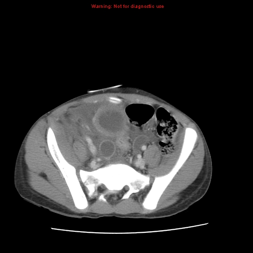 Appendicitis with phlegmon (Radiopaedia 9358-10046 A 54).jpg