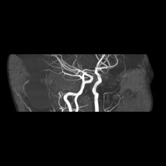 File:Artery of Percheron infarct (Radiopaedia 40966-43676 G 14).jpg