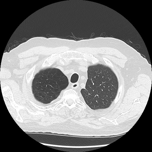 Asbestos-related pleural disease (Radiopaedia 74366-85250 Axial lung window 21).jpg