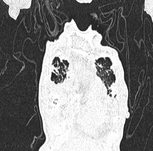 Aspergilloma- with Monod sign (Radiopaedia 44737-48532 Coronal lung window 131).jpg