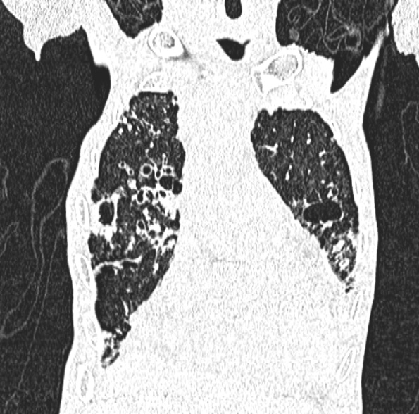 Aspergilloma- with Monod sign (Radiopaedia 44737-48532 Coronal lung window 169).jpg