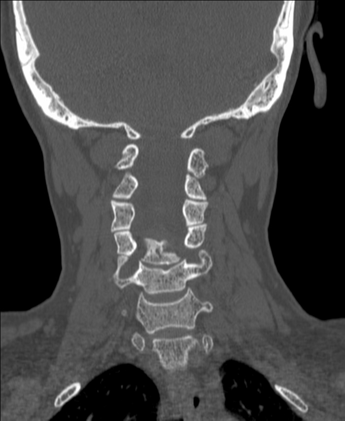 Atlanto-occipital assimilation with basilar invagination (Radiopaedia 70122-80188 Coronal bone window 127).jpg