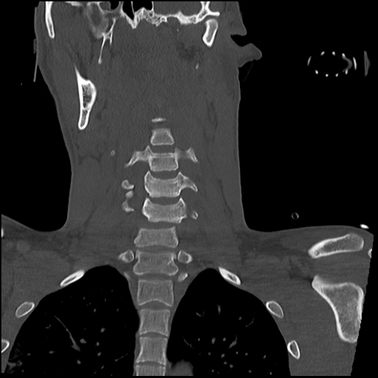 Atlanto-occipital dissociation (Traynelis type 1), C2 teardrop fracture, C6-7 facet joint dislocation (Radiopaedia 87655-104061 Coronal bone window 34).jpg