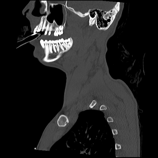 Atlanto-occipital dissociation (Traynelis type 1), C2 teardrop fracture, C6-7 facet joint dislocation (Radiopaedia 87655-104061 Sagittal bone window 13).jpg