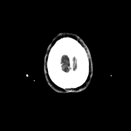 Atretic cephalocele (Radiopaedia 89782-106881 Axial with contrast 180).jpg