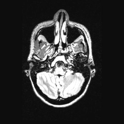 Atretic encephalocoele with inferior vermis hypoplasia (Radiopaedia 30443-31108 Axial 37).jpg