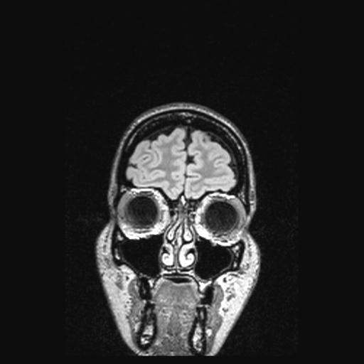 File:Atretic encephalocoele with inferior vermis hypoplasia (Radiopaedia 30443-31108 Coronal FLAIR 159).jpg