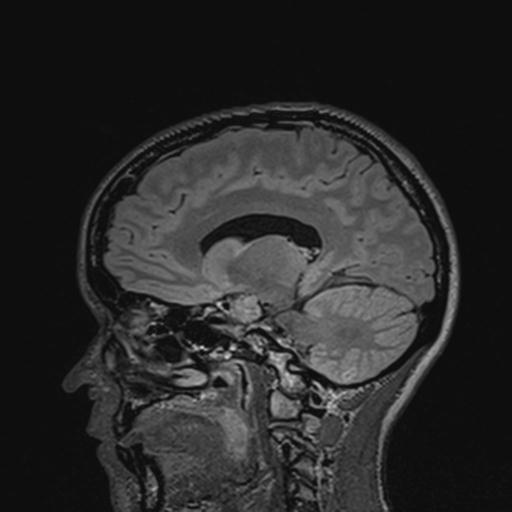 Atretic encephalocoele with inferior vermis hypoplasia (Radiopaedia 30443-31108 Sagittal FLAIR 71).jpg