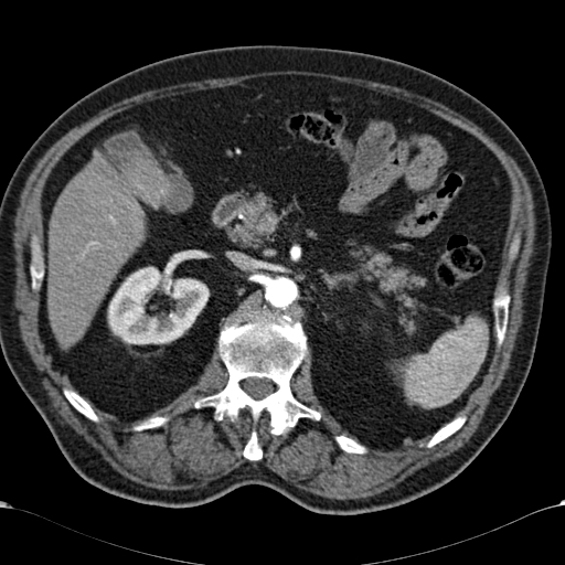 Atypical hepatocellular carcinoma (Radiopaedia 41744-44698 A 39).jpg
