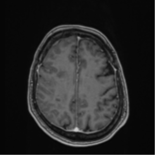 Atypical meningioma (WHO Grade II) (Radiopaedia 54742-60979 Axial T1 C+ 48).png