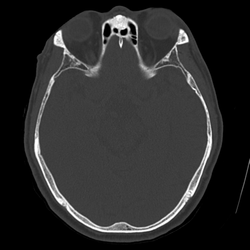 Atypical meningioma (WHO grade II) with osseous invasion (Radiopaedia 53654-59715 Axial bone window 34).png