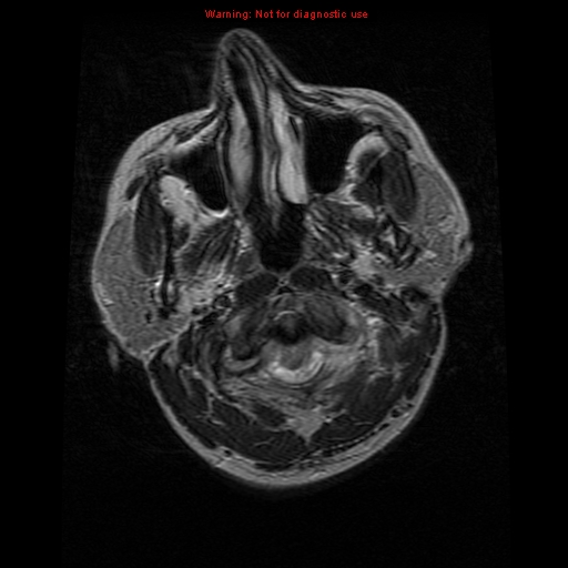 File:Atypical meningioma - grade II (Radiopaedia 13303-13305 Axial T2 1).jpg