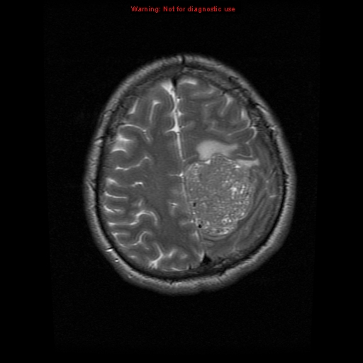 File:Atypical meningioma - grade II (Radiopaedia 13303-13305 Axial T2 18).jpg