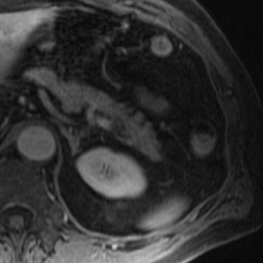 File:Atypical renal cyst on MRI (Radiopaedia 17349-17046 D 6).jpg